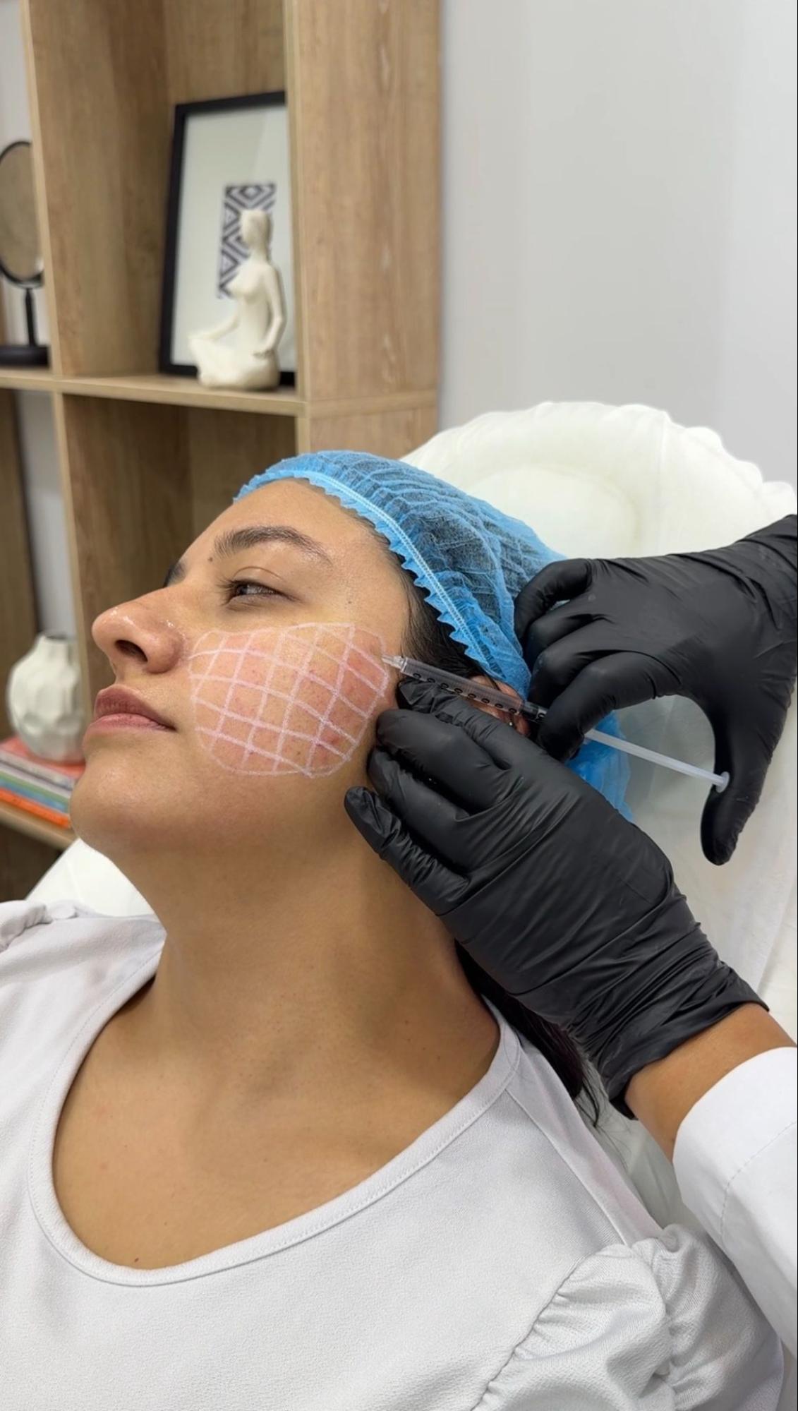 Calidad de Piel (Mesobotox) process