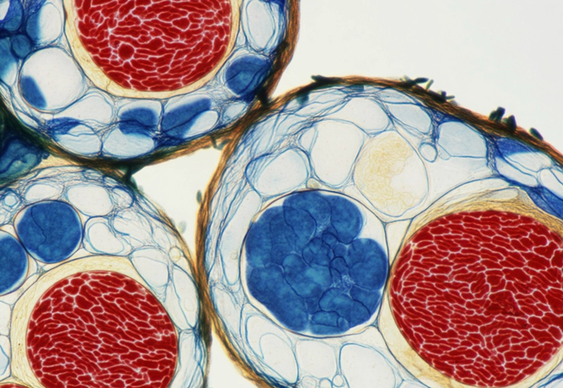 Terapia con Células Madre para la Osteoartritis de Rodilla: Resultados Reales y Datos de Reducción del Dolor