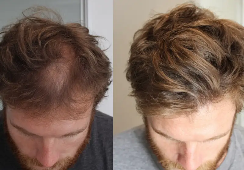 Stem Cells and Hair Growth: 9 Proven Benefits and What to Expect in 2027