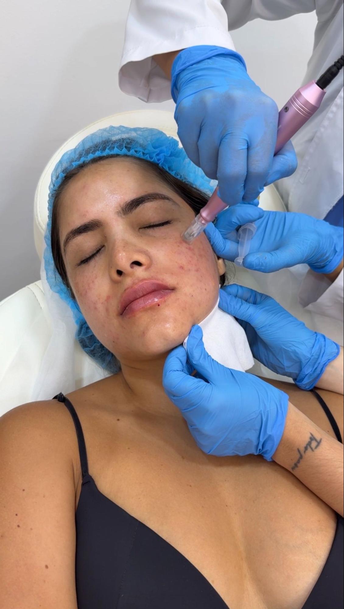Microneedling process