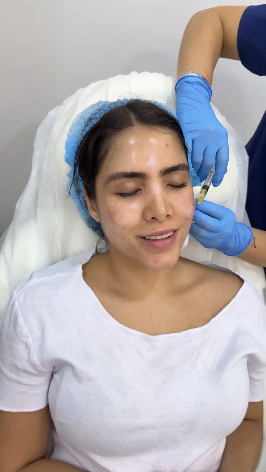 Skin Rejuvenation PRP before and after